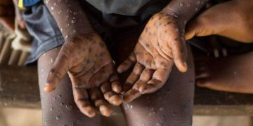 Una nueva amenaza: la viruela del mono