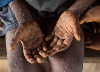 Una nueva amenaza: la viruela del mono